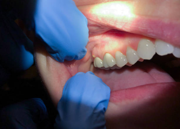 Best Emergency Tooth Extraction in Fox Island, WA